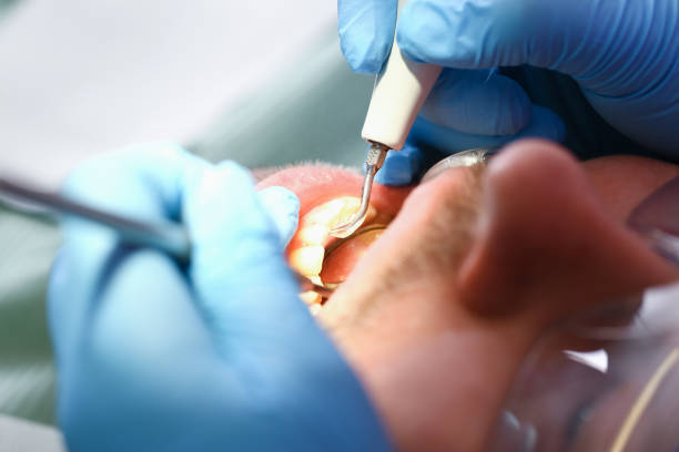 Best Knocked-Out Tooth (Avulsed Tooth) Treatment in Espy, PA